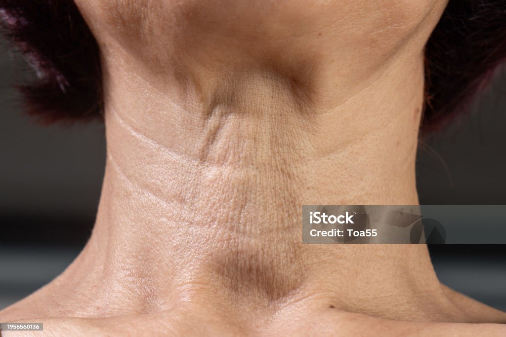 neck wrinkles